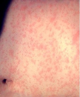 Measles rash on stomach