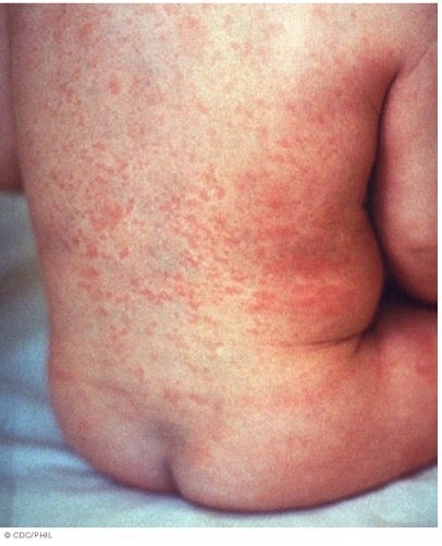 German measles on back 