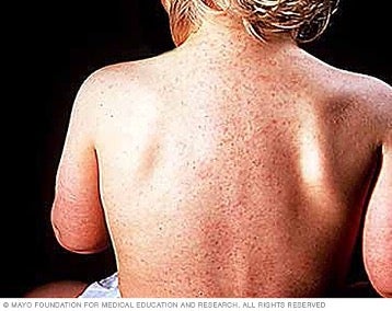 Roseola Infantum on back 