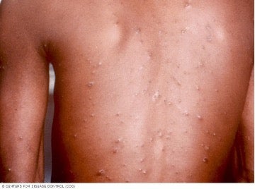 Chicken pox