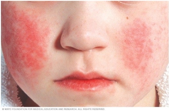 Fifth Disease