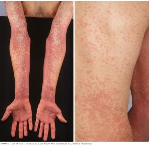 Scarlet Fever