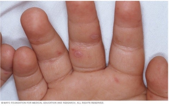 Hand Foot Mouth Disease